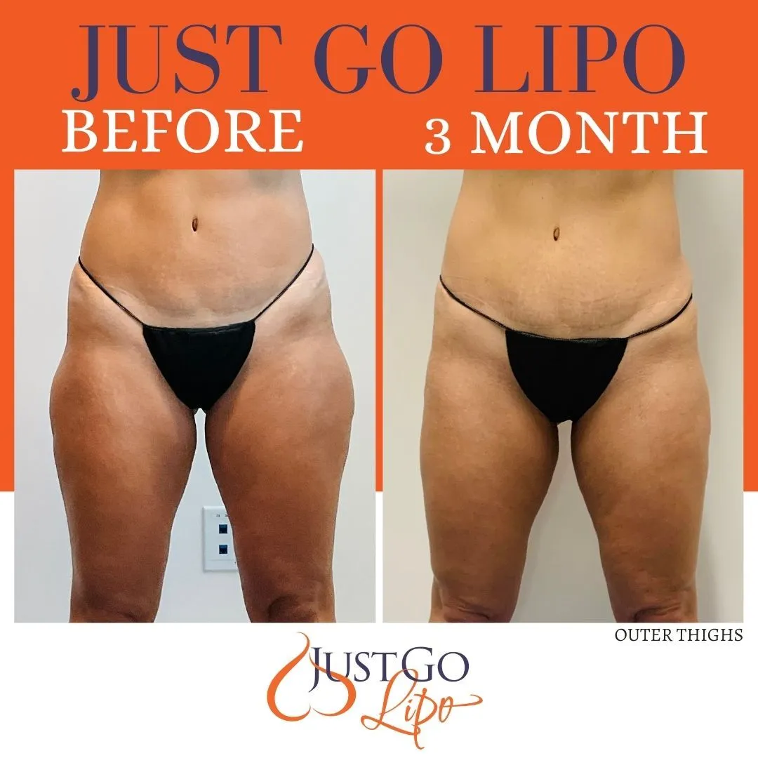 The Vaser Liposuction Procedure: Patient