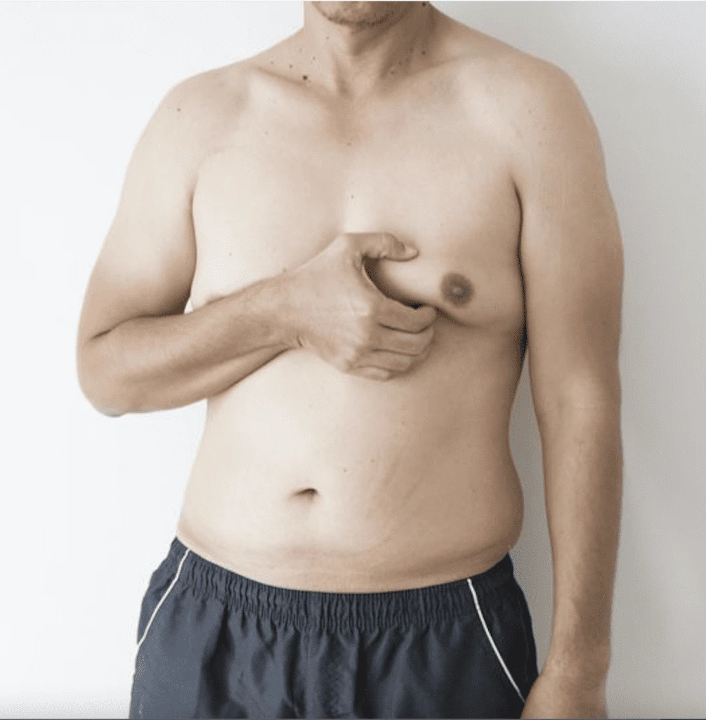 male with gynecomastia