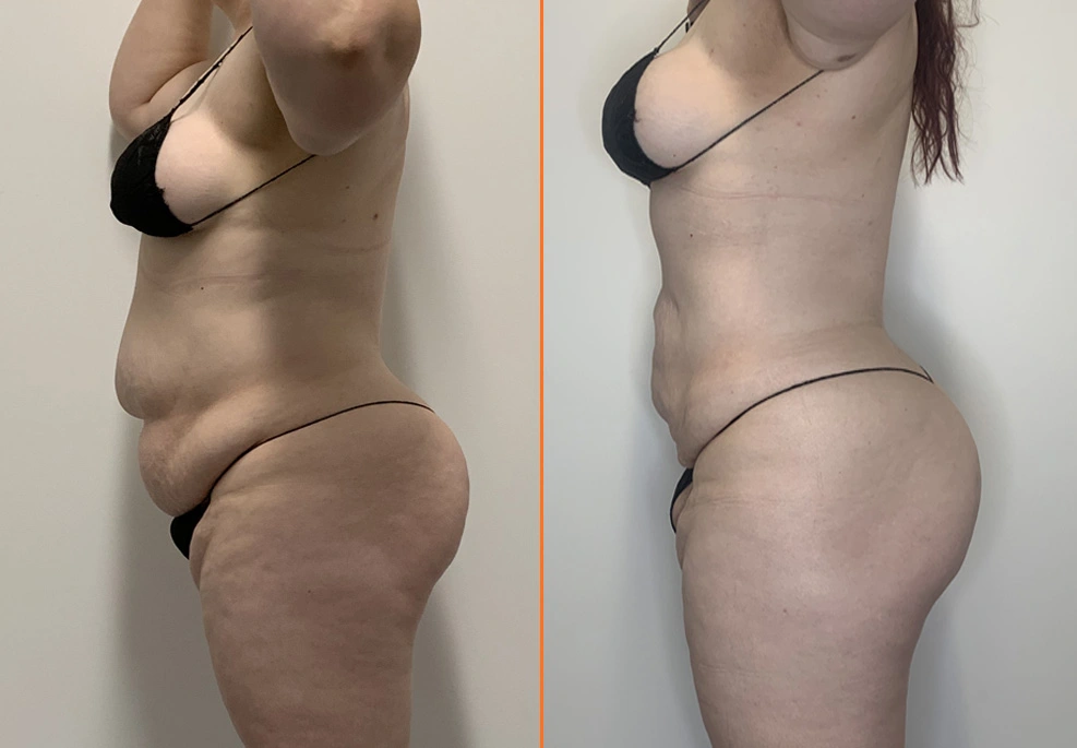 Lipo 360 Case 1 Side