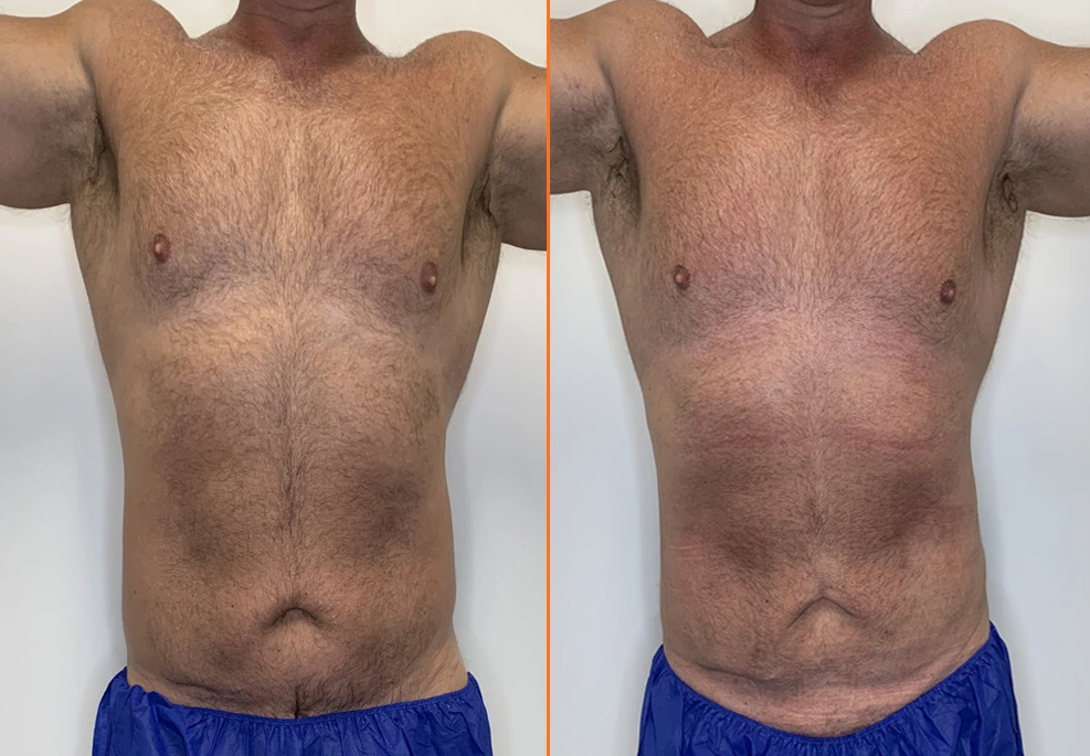 Lipo 360 Case -front