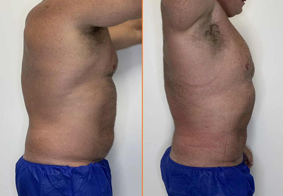 Lipo 360 Case 16 side male