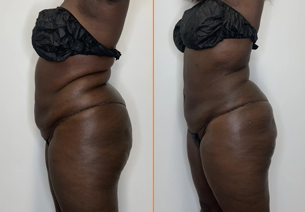 Lipo 360 Case 13-Side