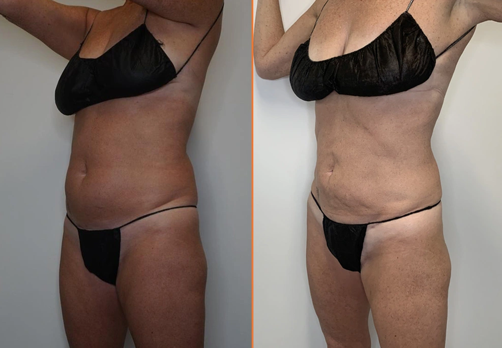 Abdominal Liposuction Case 14-oblique