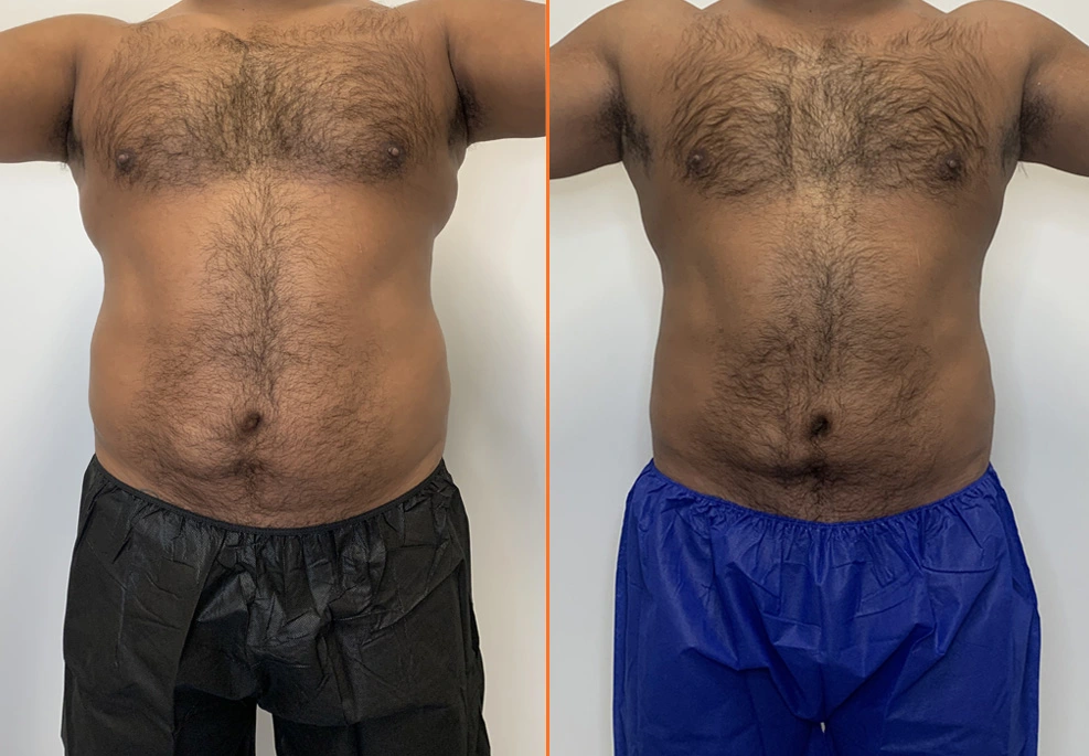 Lipo 360 Case Front Male