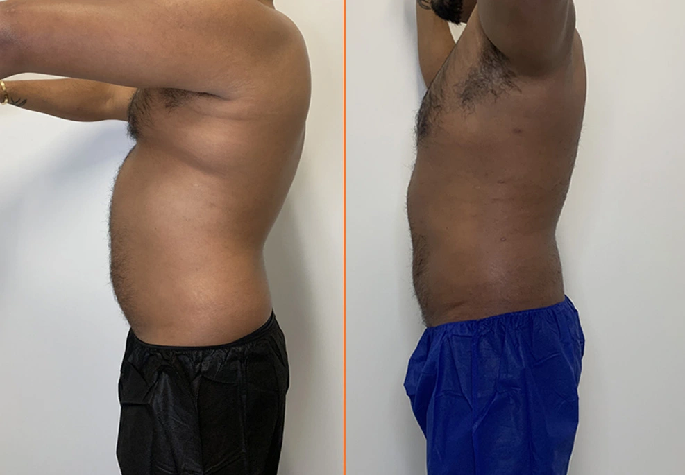 Lipo 360 Case side