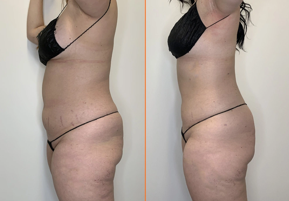 Lipo 360 Case side