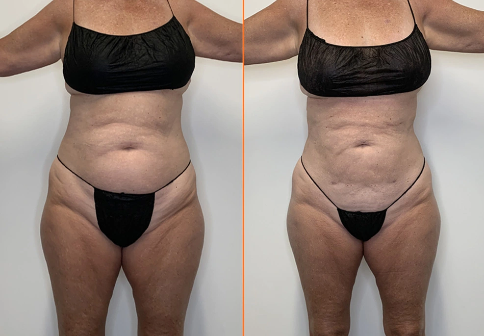 Lipo 360 22-Front.jpg