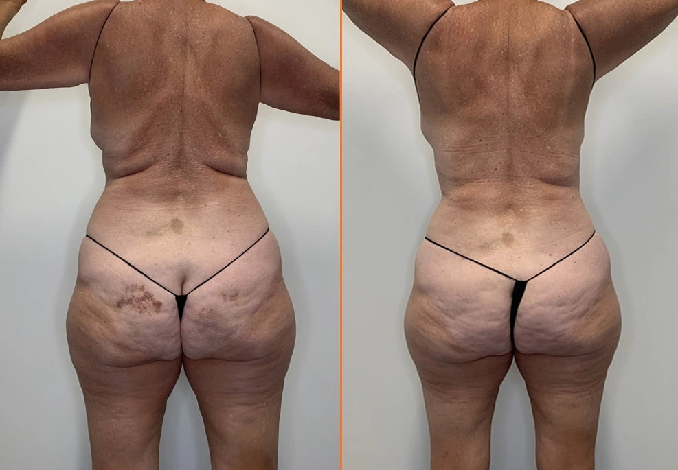 Lipo 360 Case back