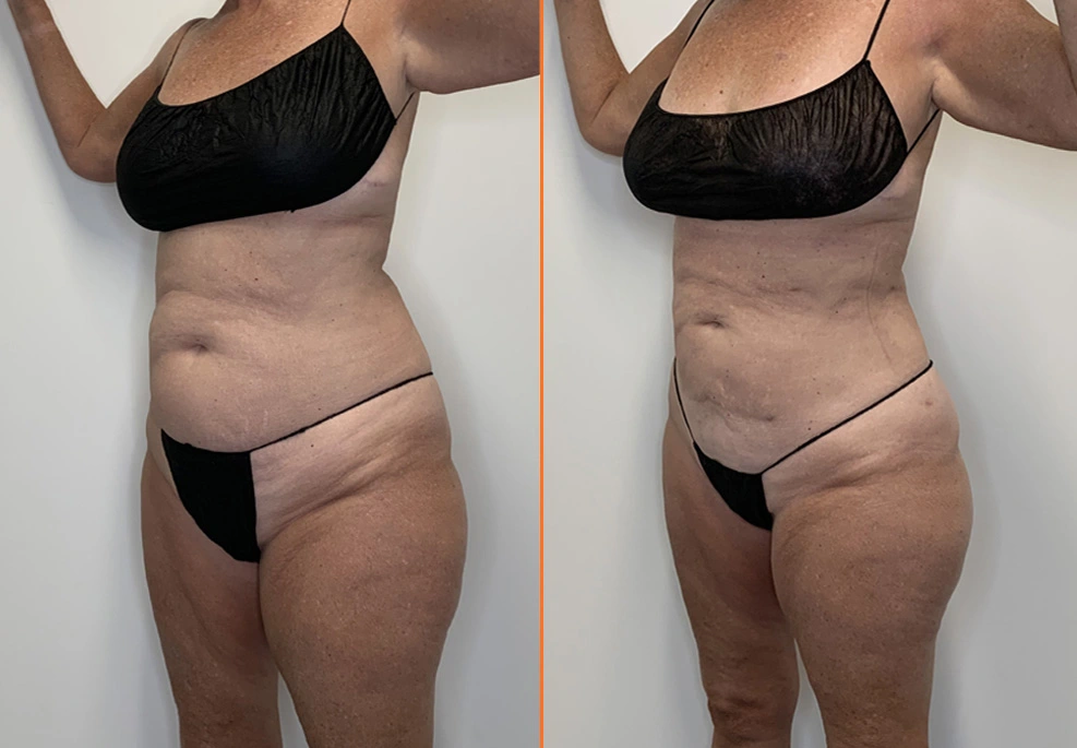 Lipo 360 Case 22