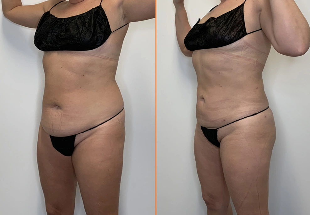 Lipo 360 Case oblique