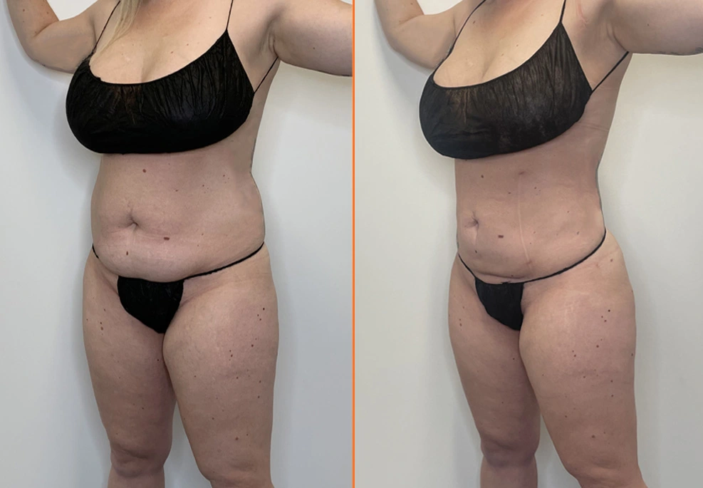 Lipo 360 oblique