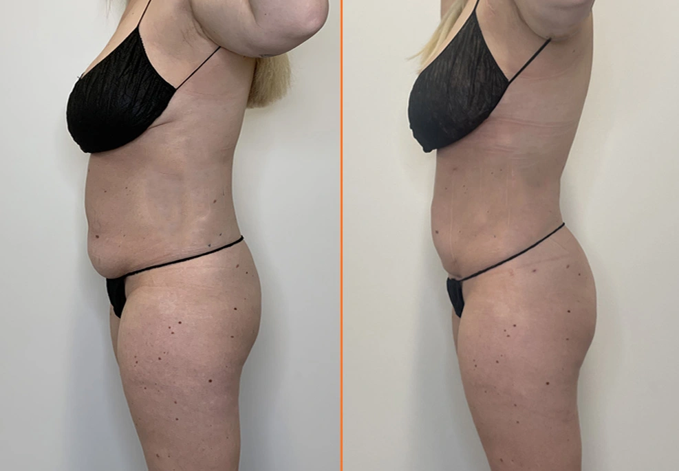 Lipo 360 side