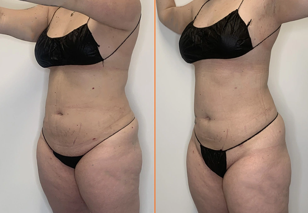 Case-8-oblique