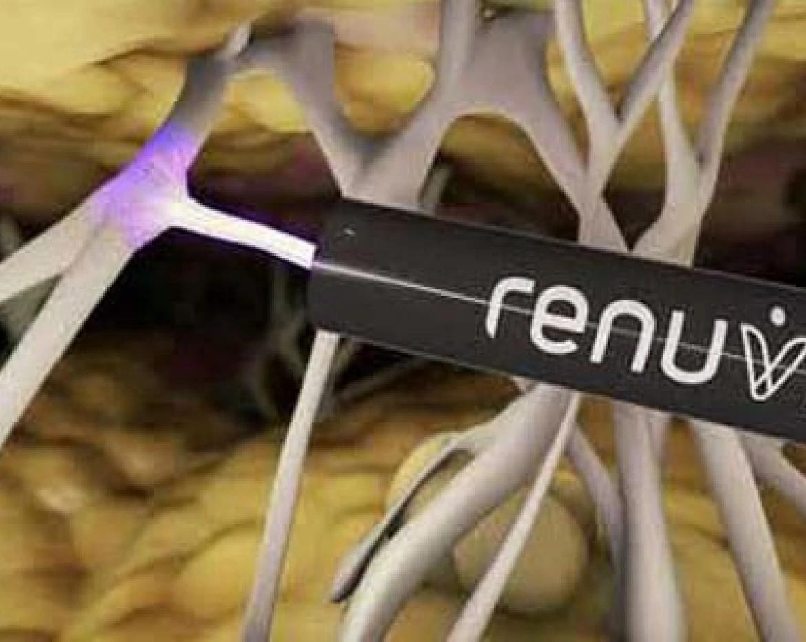 Our Alternatives to Arm Lift Surgery: Renuvion Banner