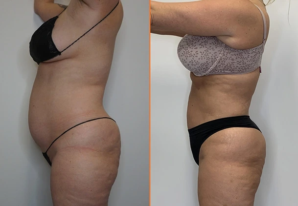 View our Abdominal Liposuction results Banner