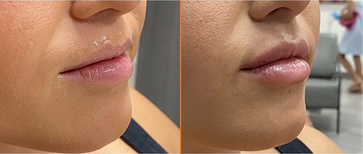 View our Lip Fillers results Banner